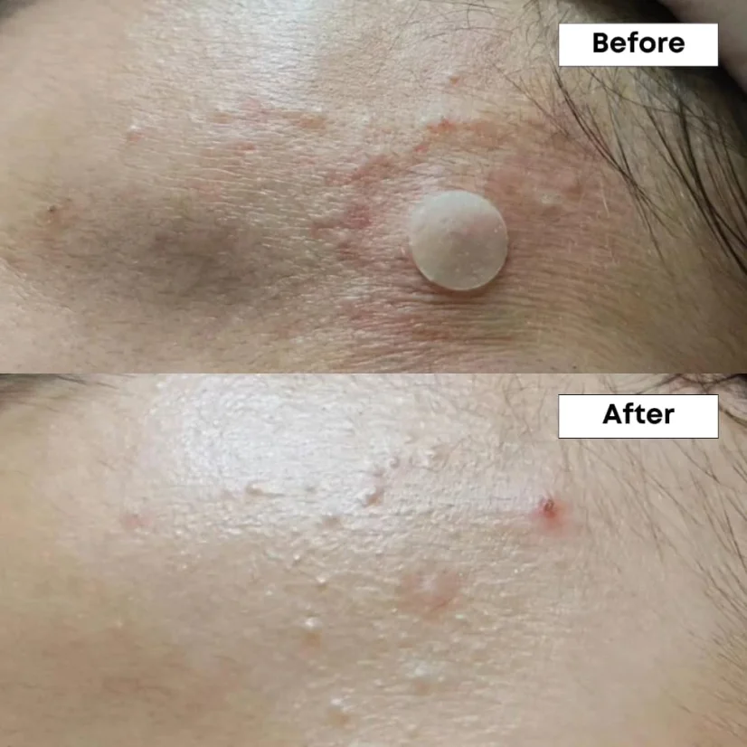 NINELESS - A-Control 10% Azelaic Acid Serum 30ml